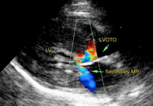 Concentric left ventricular hypertrophy in 5 chamber right parasternal long axis with bidirectional turbulence through the LVOT and mitral regurgitation typical for feline HCM.