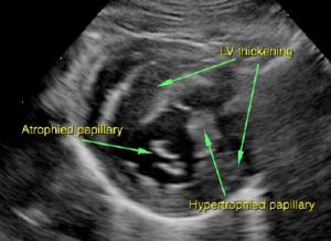 Sectorial LV hypertrophy demonstrated in right parasternal short axis.