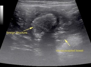 Sept. 2017 “Acute abdominal pain doesn’t always add up to foreign body!”  – Sonopath’s Case of the Month – Intramural abscess