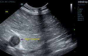 Aldosterone Secreting Adrenal Tumor in an 11-Year-Old FS DSH Cat: Our Case Of the Month June 2019