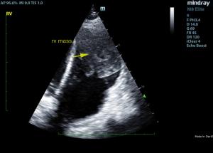Cardiac Mass In An 11-year-old MN Doberman Pinscher: Our Case Of the Month Feb. 2020