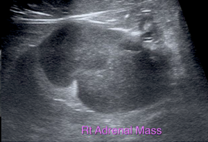 Conn’s Syndrome/Right Adrenal Gland Mass In An 11-Year-Old FS DSH : Our Case Of the Month June 2020